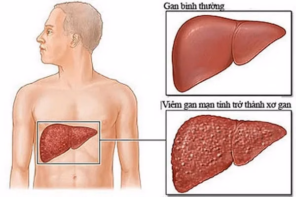 Mô hình tổn thương cấu trúc mô gan kéo dài trong bệnh lý viêm gan mạn