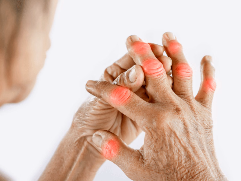 Khớp bàn ngón chân cái sưng tấy đỏ rực do viêm trong cơn gout cấp tính