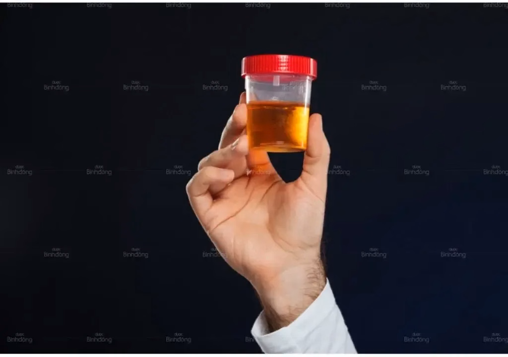 Biểu hiện sưng phù mi mắt và nước tiểu đổi màu nâu sẫm giống nước ngọt coca ở người bệnh viêm cầu thận sau nhiễm trùng