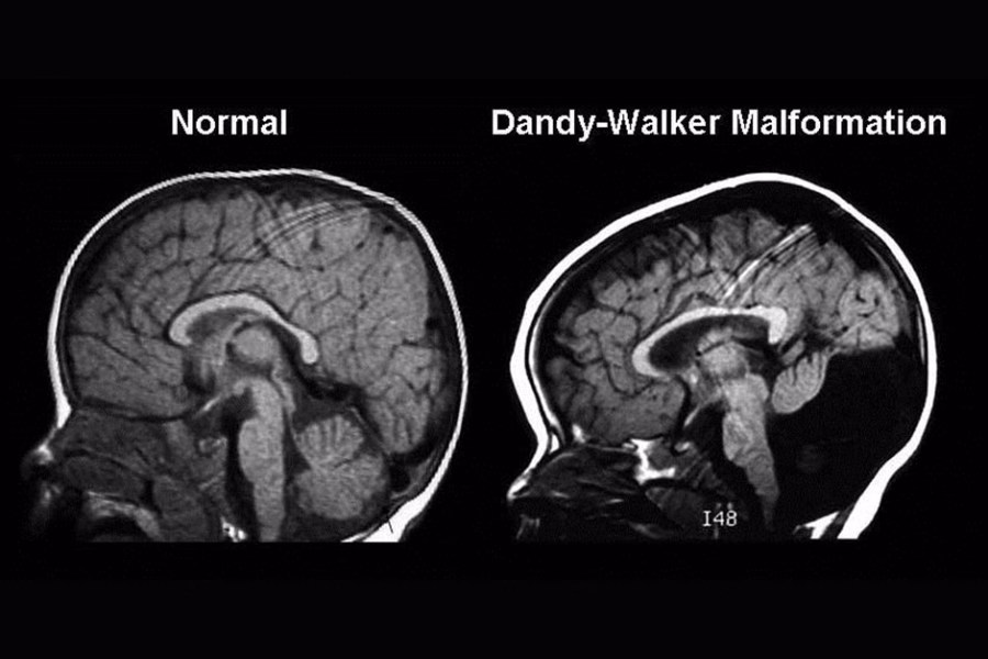 Hình ảnh mô phỏng cấu trúc hố sau não bộ và vị trí tiểu não liên quan đến dị tật Dandy-Walker