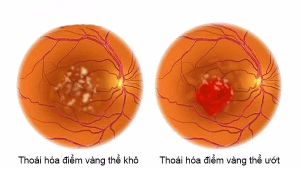 Hình ảnh giải phẫu vị trí hoàng điểm ở võng mạc và cơ chế lắng đọng chất cặn trong thoái hóa điểm vàng