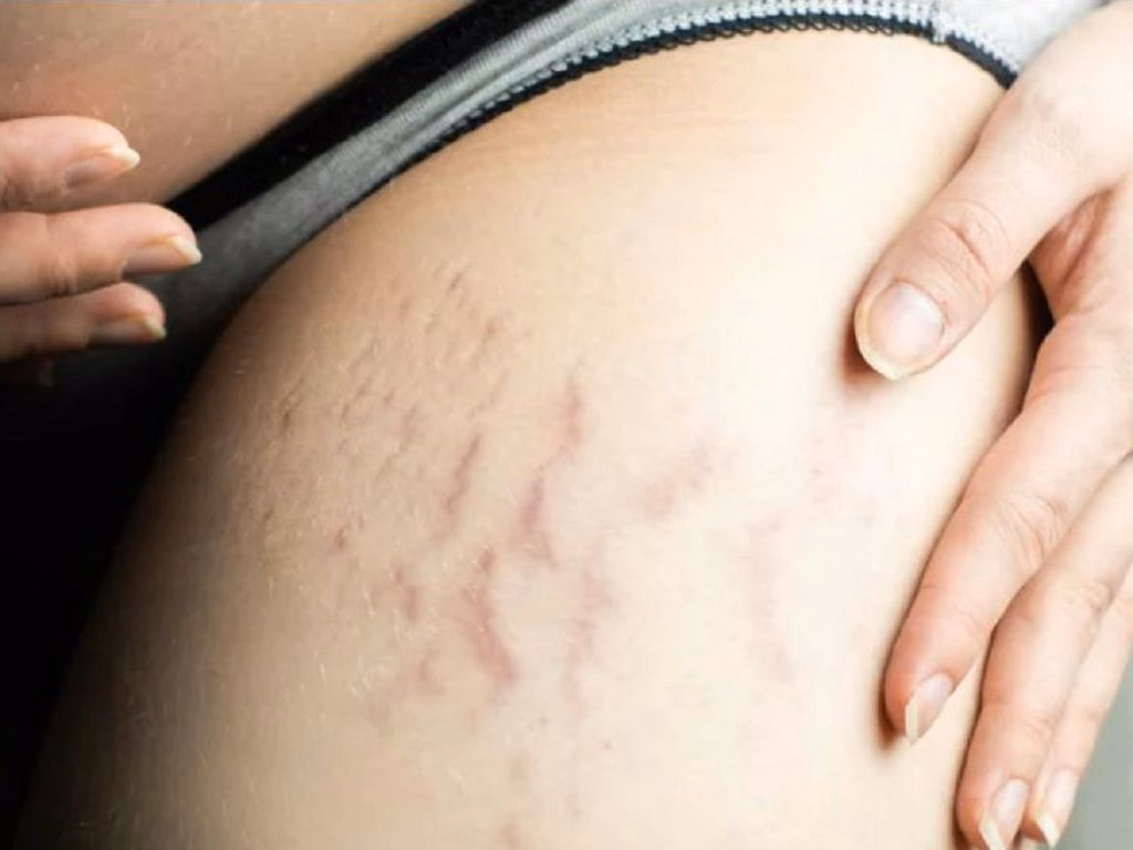 Hình ảnh các vết rạn da màu đỏ và màu trắng xuất hiện ở vùng thành bụng và đùi