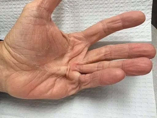 Bàn tay người bệnh co rút Dupuytren ở giai đoạn tiến triển với ngón áp út bị co rút gập sâu vào lòng bàn tay