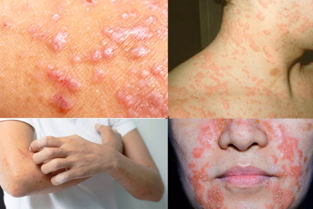 Hình ảnh tổn thương ban đỏ và mụn nước li ti đặc trưng của viêm da cơ địa ở trẻ nhỏ
