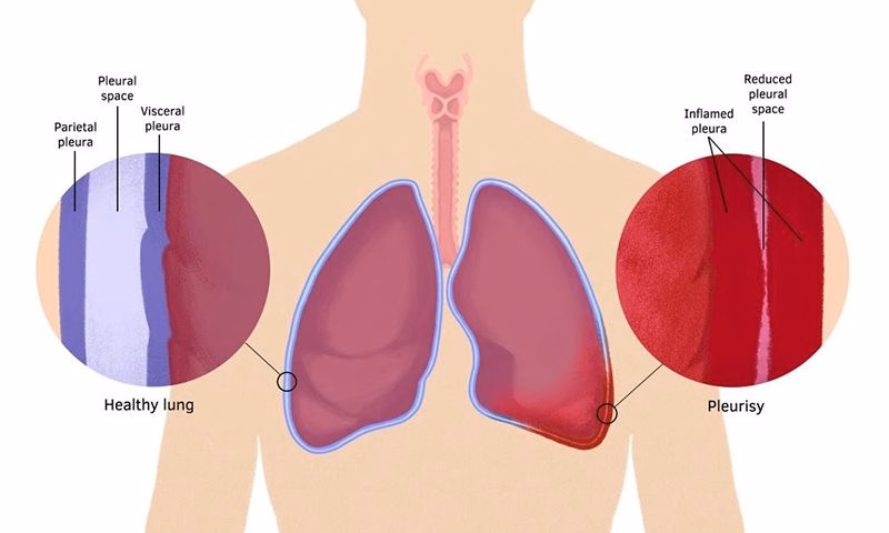Hình ảnh giải phẫu vị trí khoang màng phổi và cơ chế tổn thương viêm gây cọ xát thanh mạc