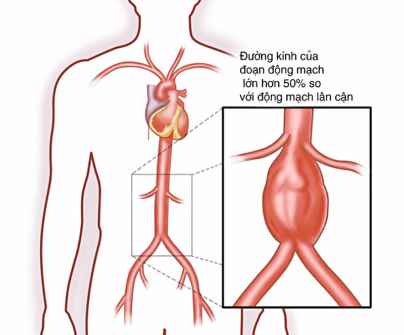 Hình ảnh giải phẫu vị trí quai động mạch chủ và cấu trúc thành mạch máu bị tổn thương do viêm động mạch chủ
