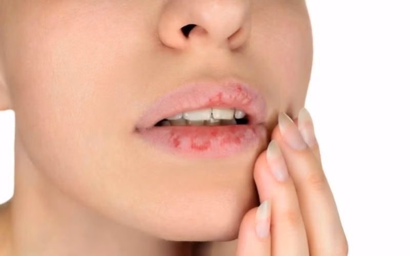 Cận cảnh bờ môi bị viêm đỏ sưng nề và bong tróc vảy do chàm môi