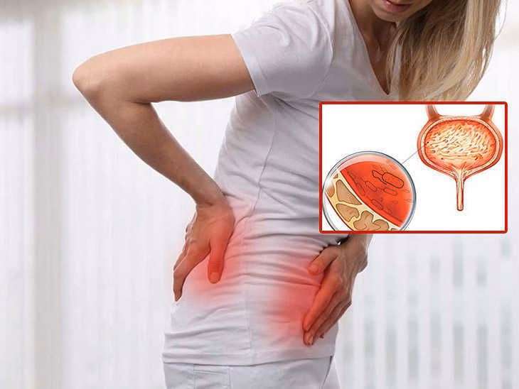 Hình ảnh mô phỏng vị trí viêm bàng quang mạn tính và cấu trúc niêm mạc tổn thương ở hệ tiết niệu