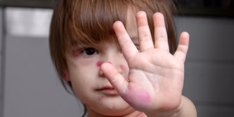 Biểu hiện phát ban dạng dát sẩn và mụn nước của bệnh thủy đậu trên da trẻ em
