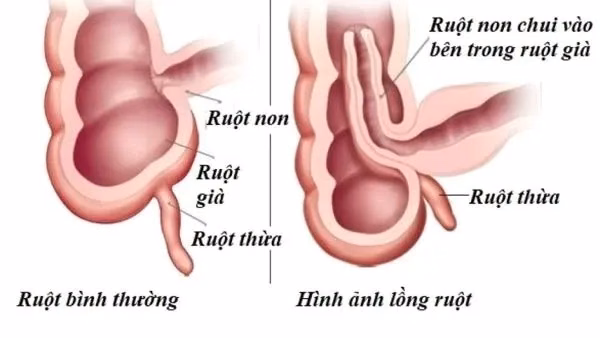 Hình ảnh mô phỏng giải phẫu cơ chế một đoạn quai ruột non chui lồng vào lòng ruột già gây tắc nghẽn cơ học