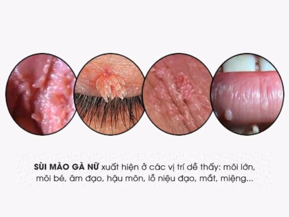 Bác sĩ chuyên khoa thăm khám và tư vấn điều trị sùi mào gà cho người bệnh