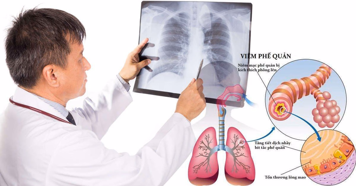 Bác sĩ thực hiện thăm khám lâm sàng bằng ống nghe để kiểm tra chức năng phổi của bệnh nhân viêm phế quản