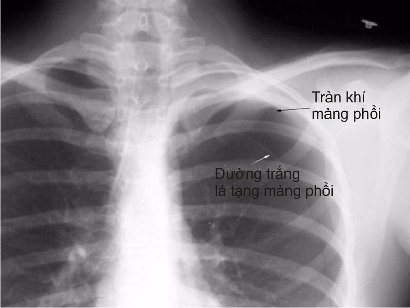 Hình ảnh minh họa giải phẫu lồng ngực và cơ chế tràn khí màng phổi gây xẹp phổi