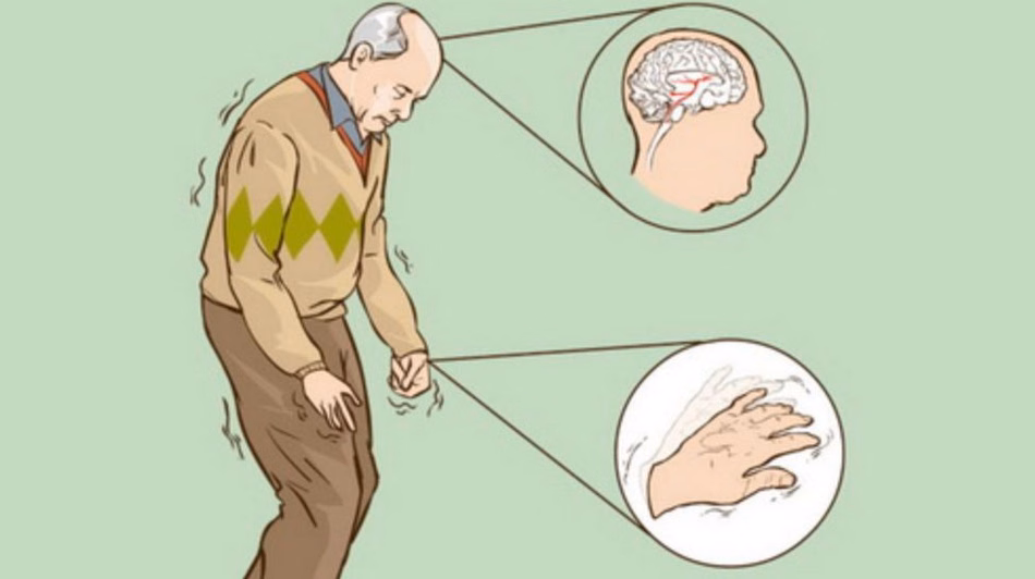 Bác sĩ chuyên khoa thần kinh đang thực hiện kiểm tra phản xạ và đánh giá chức năng vận động cho người bệnh run rẩy