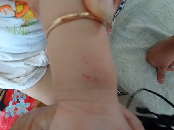 Hướng dẫn kỹ thuật băng ép bất động chi bị rắn cắn đúng cách để làm chậm sự lan tỏa của nọc độc vào tuần hoàn
