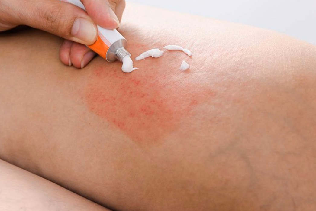 Bác sĩ chuyên khoa da liễu đang thăm khám tổn thương da và tư vấn phác đồ điều trị giảm ngứa an toàn
