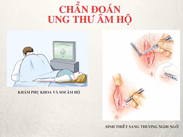 Bác sĩ chuyên khoa phụ khoa thực hiện khám lâm sàng và tư vấn tầm soát bệnh lý âm hộ