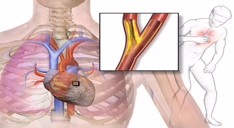 Người bệnh có biểu hiện cơn đau thắt ngực đè nặng sau xương ức do bệnh mạch vành