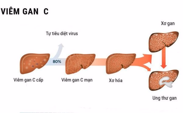 Bác sĩ chuyên khoa tiêu hóa gan mật tư vấn kết quả xét nghiệm máu chẩn đoán viêm gan C cho người bệnh
