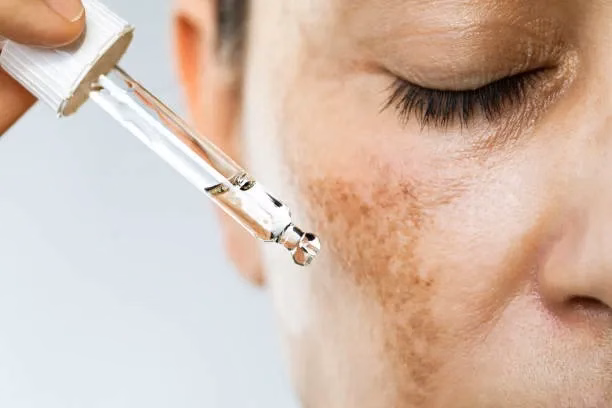 Minh họa các vùng phân bố nám da điển hình đối xứng trên trán gò má mũi và cằm