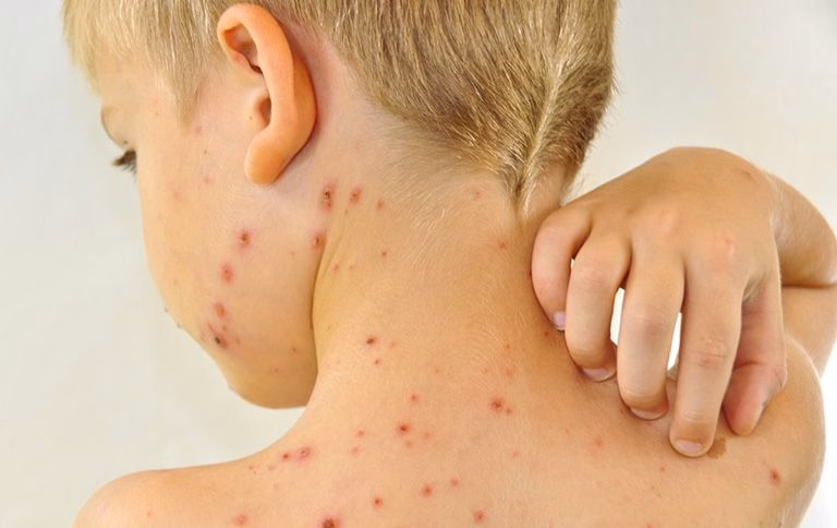 Hình thái tổn thương mụn nước căng bóng chứa dịch trong của bệnh thủy đậu
