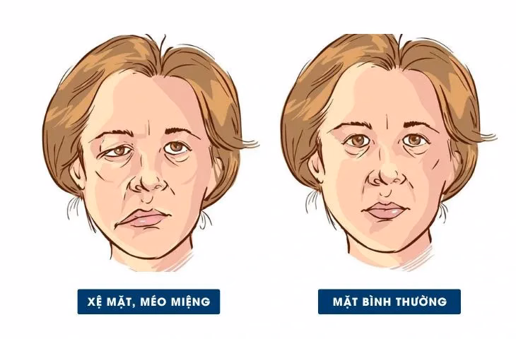 Hình ảnh minh họa người bệnh liệt mặt ngoại biên với biểu hiện méo miệng và mắt nhắm không kín