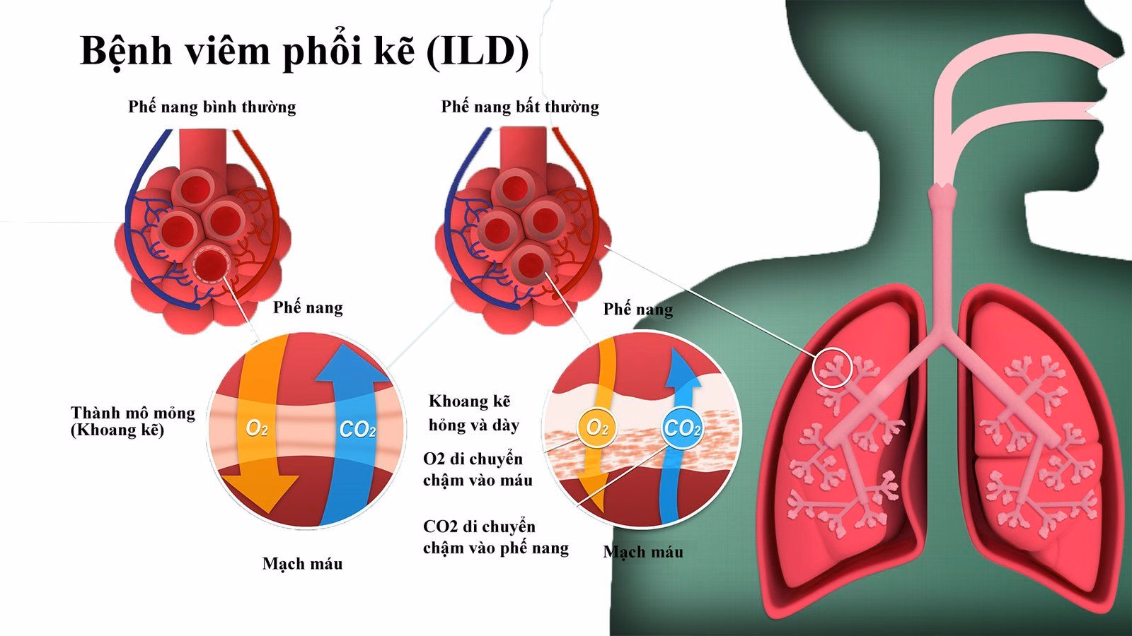 Bác sĩ thăm khám chức năng hô hấp và tư vấn cho người bệnh mắc viêm phổi kẽ lympho bào