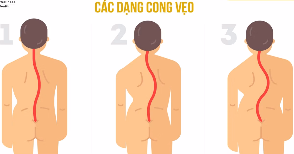 Hình minh họa các dạng lệch trục cơ thể và mất cân đối xương vai khung chậu do cong vẹo cột sống