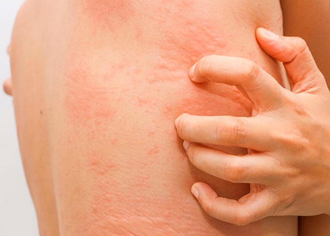 Biểu hiện nổi mẩn đỏ phát ban và mề đay trên da do phản ứng dị ứng thực phẩm
