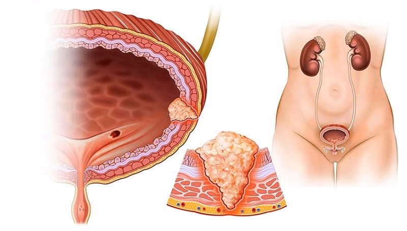 Bác sĩ chuyên khoa nam học tư vấn chẩn đoán và hướng điều trị xuất tinh ngược dòng cho bệnh nhân
