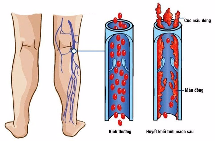 Sơ đồ minh họa cục máu đông hình thành trong lòng tĩnh mạch sâu ở bắp chân và cơ chế gây tắc nghẽn lưu thông máu