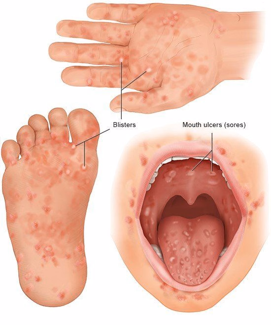 Vết loét niêm mạc miệng gây đau rát do virus đường ruột ở trẻ mắc bệnh tay chân miệng