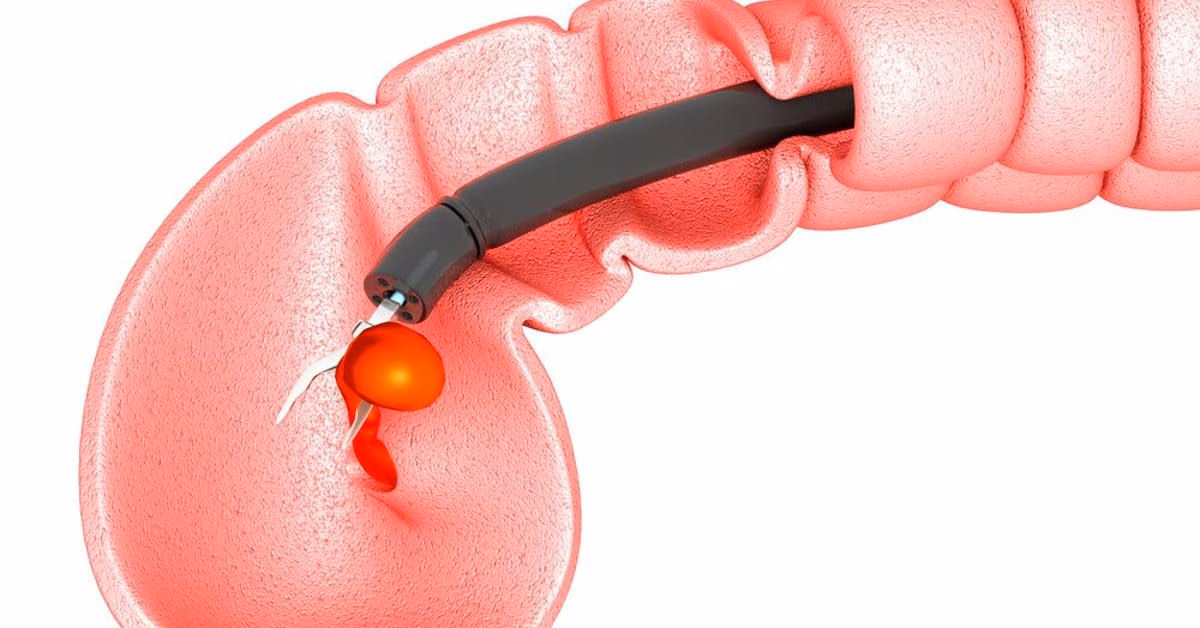 Sơ đồ giải phẫu mô tả trực tràng và quá trình can thiệp cắt polyp an toàn qua nội soi