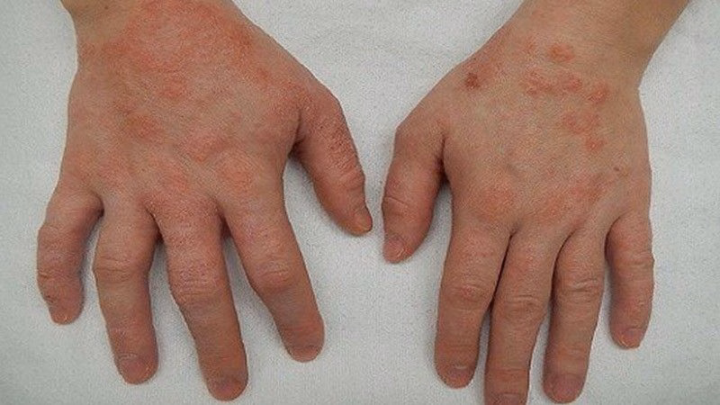 Bác sĩ chuyên khoa da liễu thăm khám và hướng dẫn chăm sóc phục hồi da cho bệnh nhân viêm da