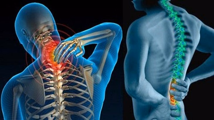 Cơn đau nhức âm ỉ tại cột sống cổ và cột sống thắt lưng do đĩa đệm mất nước