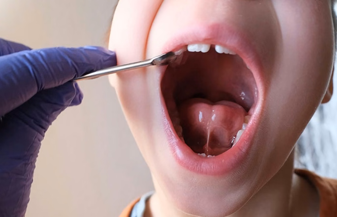 Hình ảnh mô phỏng cấu trúc thắng lưỡi bình thường và thắng lưỡi ngắn làm hạn chế cử động