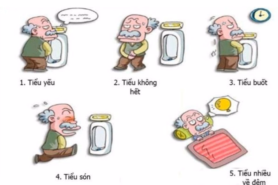 Sơ đồ cấu trúc đường tiết niệu nam giới minh họa vị trí bàng quang và tuyến tiền liệt bị tăng sinh mô đệm