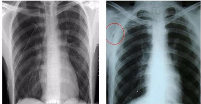 Bác sĩ chuyên khoa hô hấp thăm khám nghe phổi và tư vấn chẩn đoán viêm màng phổi cho người bệnh