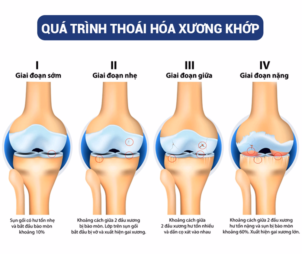 Sơ đồ các giai đoạn tiến triển của thoái hóa khớp gối từ mức độ sớm đến thoái hóa nặng