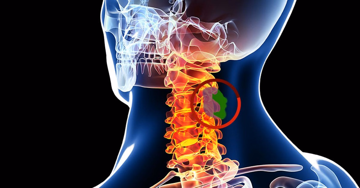 Bác sĩ chuyên khoa phân tích phim chụp cộng hưởng từ MRI cột sống để xác định khối u tủy