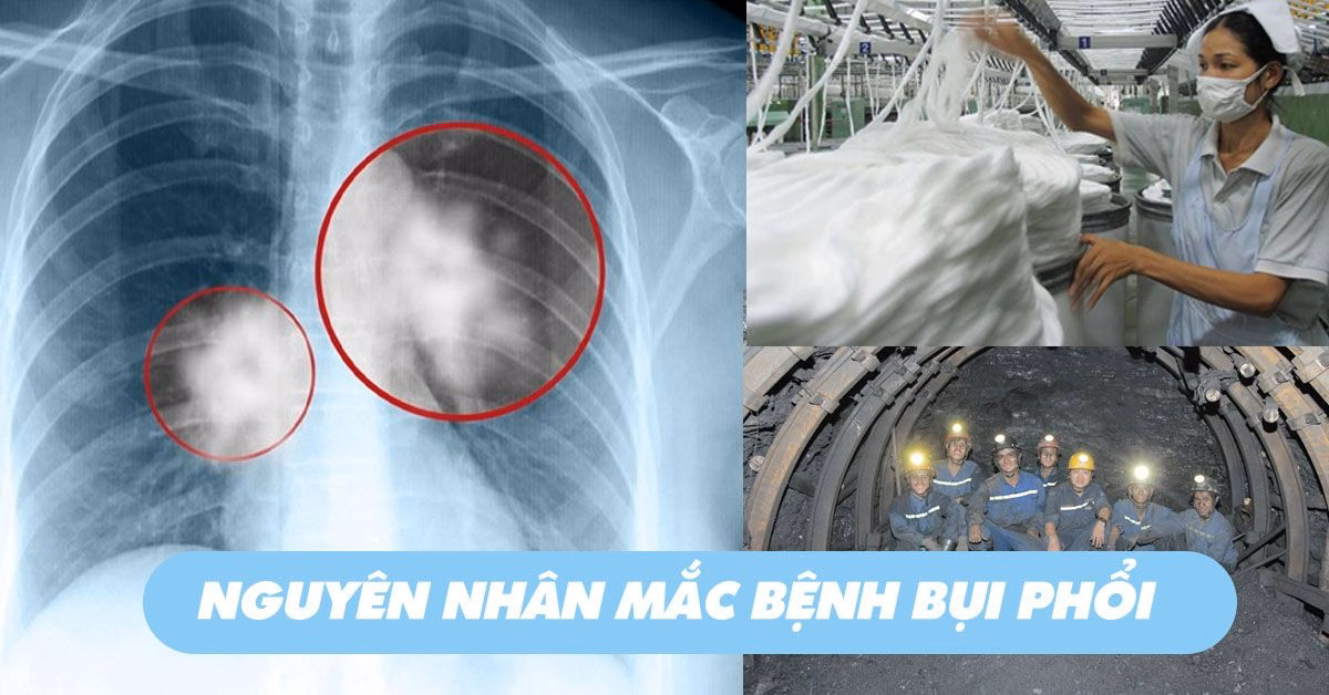 Hình ảnh phim X-quang phổi kết hợp quá trình lao động trong xưởng kéo sợi bông có nguy cơ bụi phổi