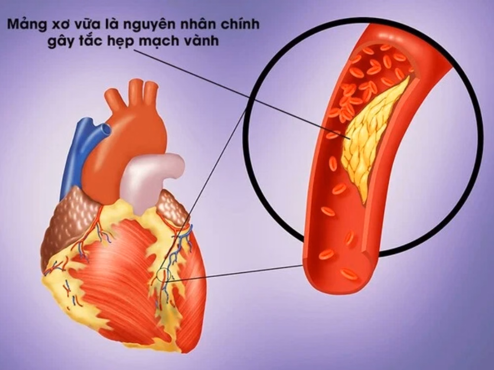 Bệnh nhân trung niên bị cơn đau thắt ngực do bệnh tim thiếu máu cục bộ