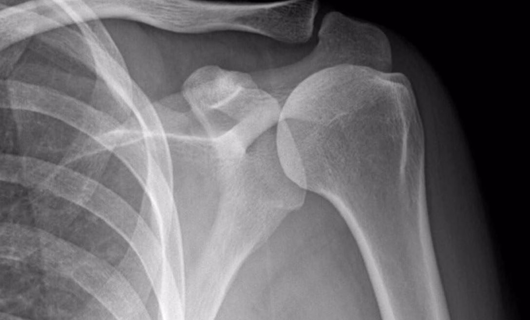 Bác sĩ chuyên khoa thăm khám kiểm tra biên độ vận động khớp vai cho người bệnh