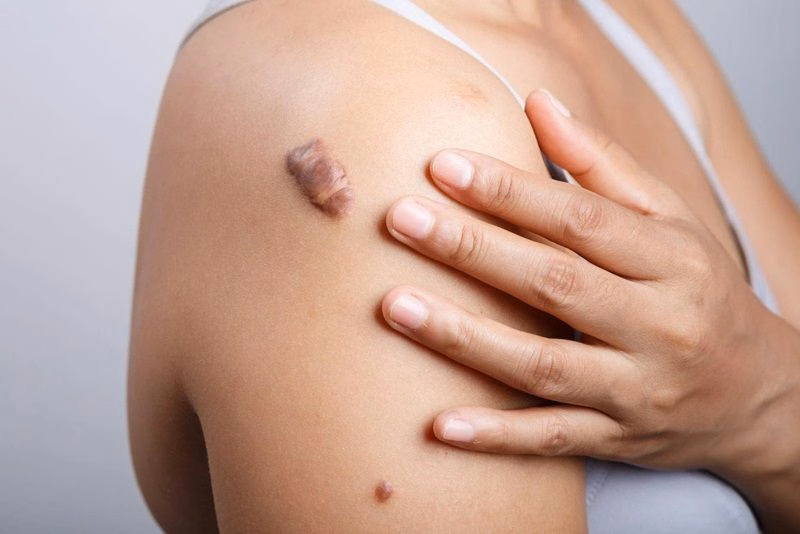 Hình ảnh minh họa cấu trúc mô sợi xơ hóa tăng sinh của sẹo lồi dưới da