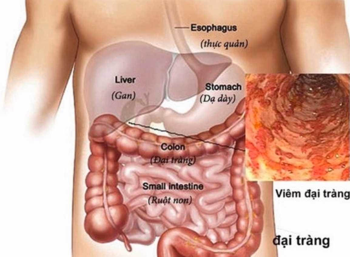 Bác sĩ chuyên khoa tiêu hóa đang thực hiện kỹ thuật nội soi đại trực tràng để chẩn đoán tổn thương niêm mạc ruột già