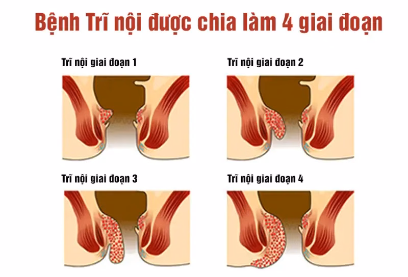 Người bệnh cảm thấy khó chịu đau rát và bất tiện khi ngồi lâu do bệnh trĩ