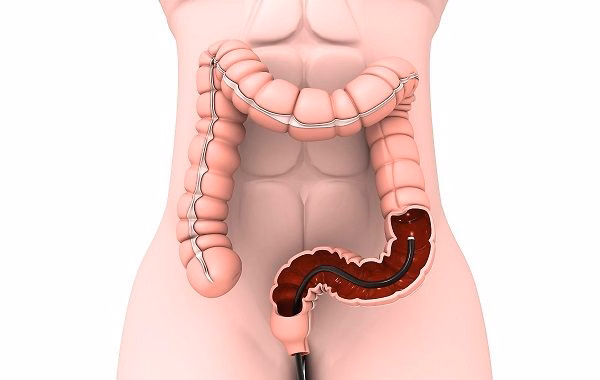 Hình ảnh mô phỏng kỹ thuật nội soi đại trực tràng giúp phát hiện tổn thương bệnh Crohn