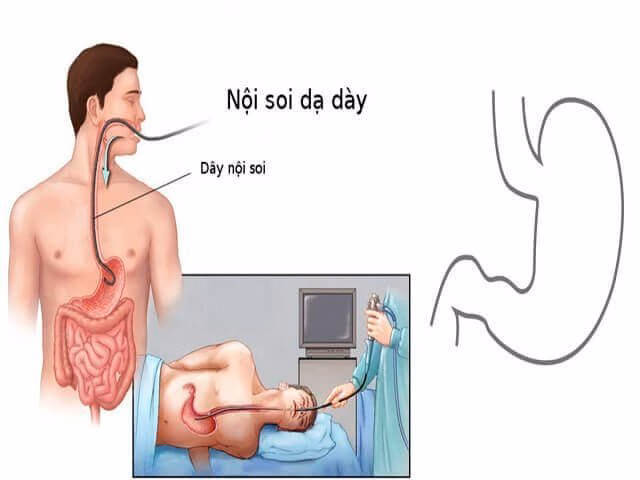 Bác sĩ chuyên khoa tiêu hóa đang thực hiện nội soi dạ dày tá tràng nhằm chẩn đoán chính xác mức độ viêm loét