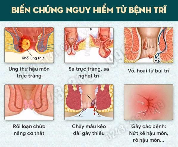 Bác sĩ chuyên khoa tiêu hóa đang thăm khám và tư vấn điều trị bệnh trĩ cho bệnh nhân