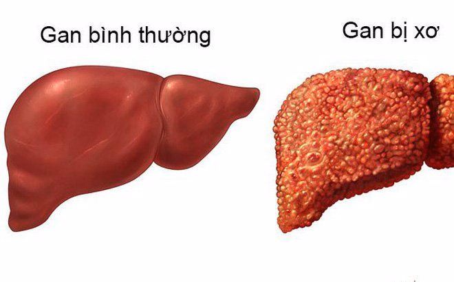 Bác sĩ chuyên khoa thực hiện thủ thuật chọc dịch màng bụng để xét nghiệm tế bào và nuôi cấy vi sinh